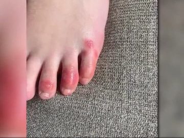 ICYMI: ‘Covid toes’ a possible new symptom of virus (4.24.20)